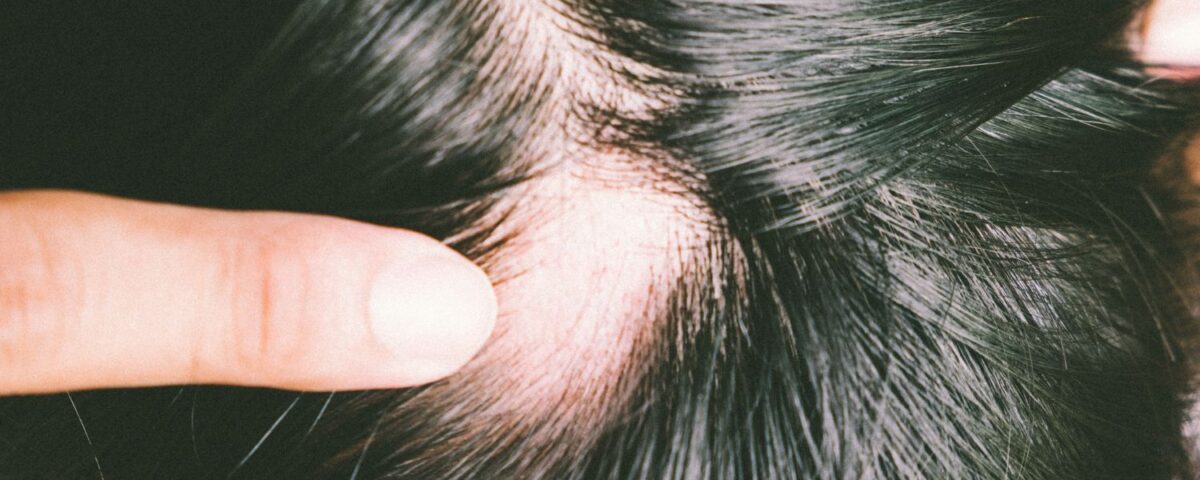 Explore the causes, impacts, and treatment options for Alopecia Areata, an autoimmune condition that leads to sudden hair loss