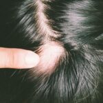 Explore the causes, impacts, and treatment options for Alopecia Areata, an autoimmune condition that leads to sudden hair loss